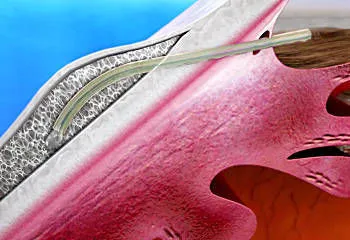 xen-gel-stent XEN Gel Stent zur Glaukom Behandlung