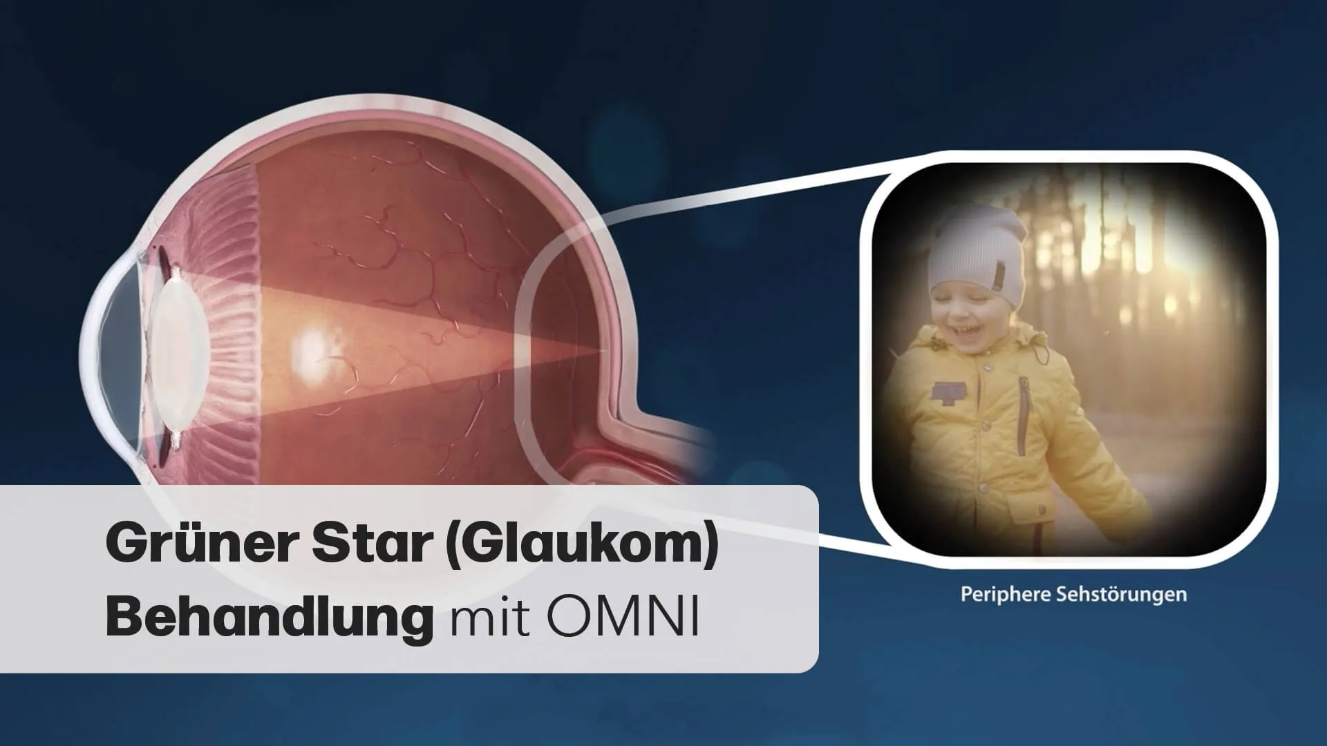 Grüner Star Behandlung - OMNI Verfahren erklärt